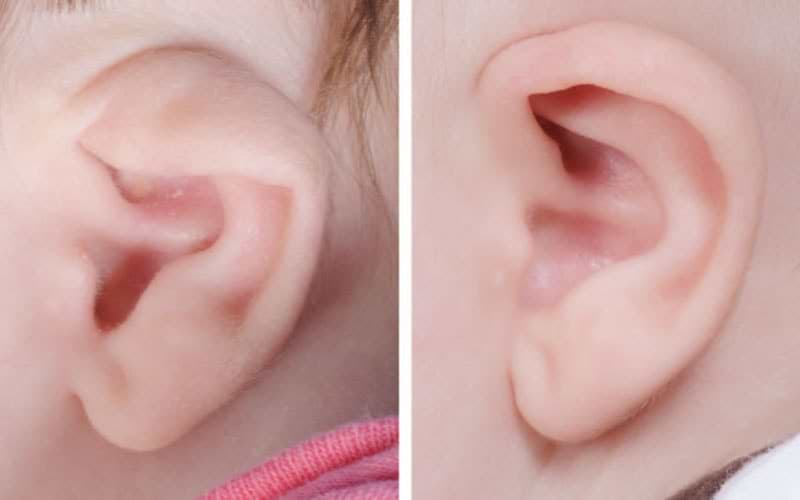 Ear Deformitieso