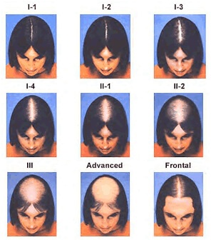 Hair Transplantation