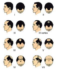 Hair Transplantation