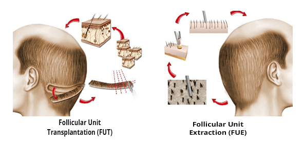 FUE and FUT Technique