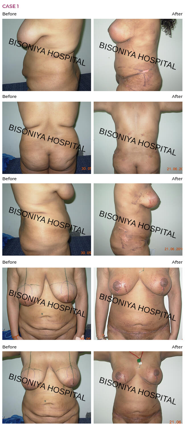 Abdominoplasty, breast reduction, liposuction in single stage