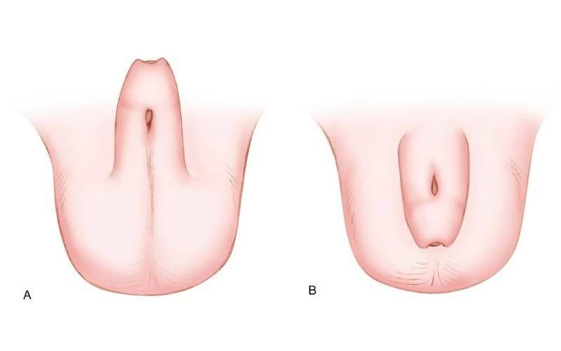 Hypospadias