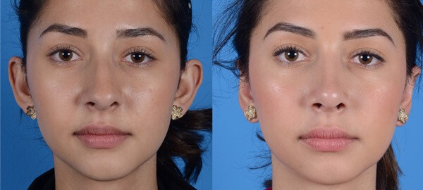 Rhinoplasty