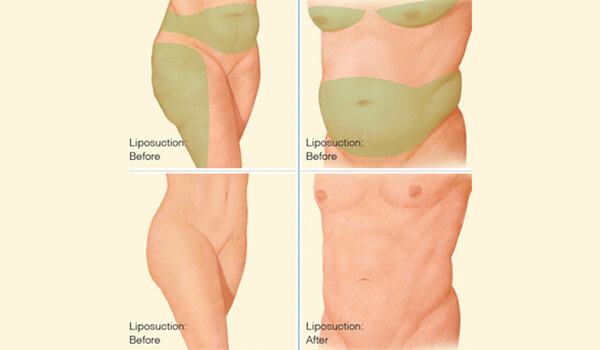 Liposuction