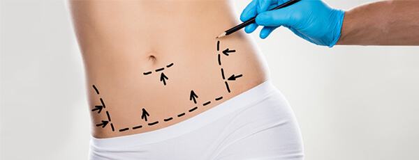 Abdominoplasty