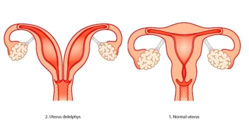 Vaginal Agenesis